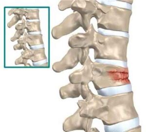 fratture_vertebrali