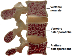 osteoporosi_vertebrale_evol