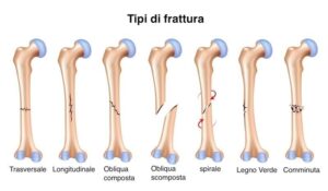 tipi-fratture-italiano