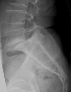 SpondylolisthesisL5S1