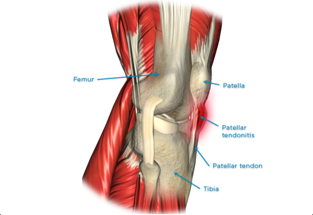 Тендинит коленных связок