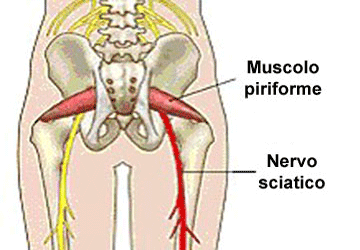 il piriforme è uno dei muscoli che può essere responsabile di una sciatalgia