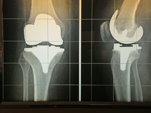 Rx protesi totale di ginocchio