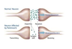 Morbo di Parkinson
