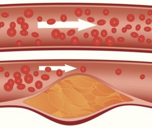 arteripatia