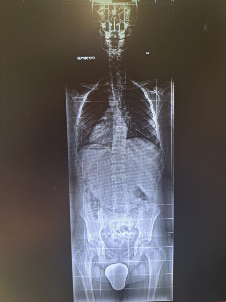 Radiografia dopo 2 mesi ginnastica posturale