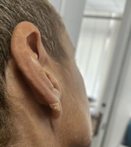 auricoloterapia